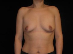 Breast Augmentation Before and After Pictures Glastonbury, CT