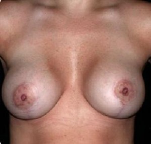 Breast Lift Before and After Pictures Glastonbury, CT