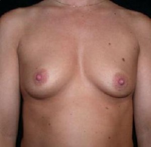 Breast Augmentation Before and After Pictures Glastonbury, CT
