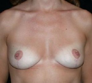 Breast Lift Before and After Pictures Glastonbury, CT