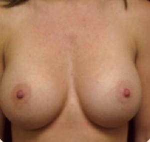 Breast Augmentation Before and After Pictures Glastonbury, CT