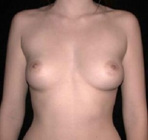 Breast Augmentation Before and After Pictures Glastonbury, CT