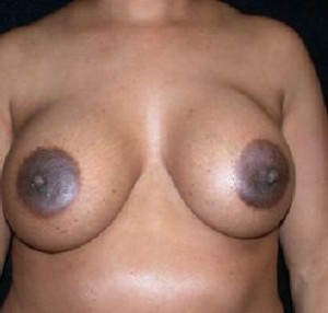 Breast Augmentation Before and After Pictures Glastonbury, CT