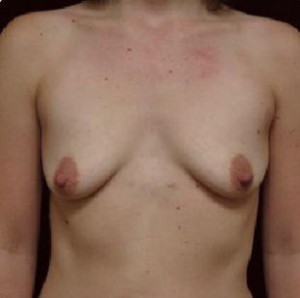 Breast Augmentation Before and After Pictures Glastonbury, CT