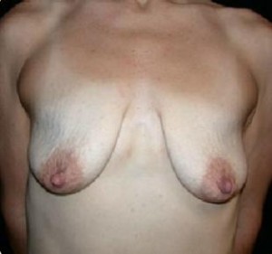 Breast Lift Before and After Pictures Glastonbury, CT