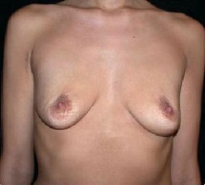 Breast Lift Before and After Pictures Glastonbury, CT