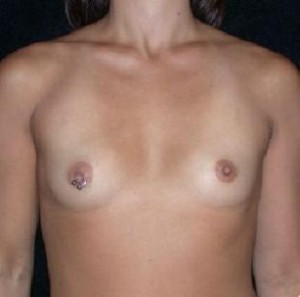 Breast Augmentation Before and After Pictures Glastonbury, CT