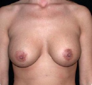 Breast Lift Before and After Pictures Glastonbury, CT