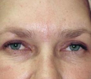 Eyelid Surgery Before and After Pictures Glastonbury, CT