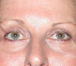 Eyelid Surgery Before and After Pictures Glastonbury, CT