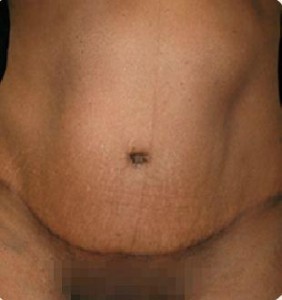 Abdominoplasty Before and After Pictures Glastonbury, CT