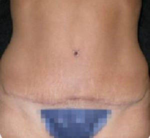 Abdominoplasty Before and After Pictures Glastonbury, CT