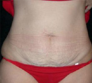 Abdominoplasty Before and After Pictures Glastonbury, CT