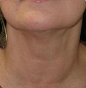 Liposuction Before and After Pictures Glastonbury, CT