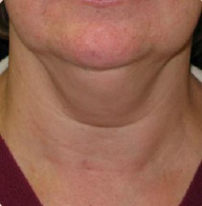 Liposuction Before and After Pictures Glastonbury, CT