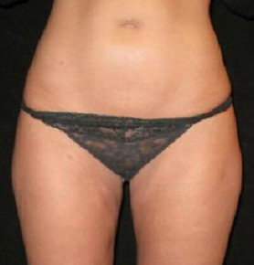 Liposuction Before and After Pictures Glastonbury, CT