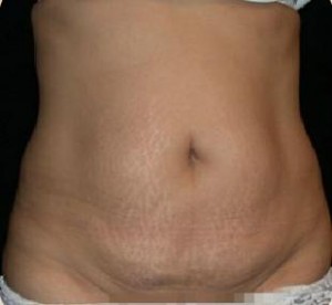 Abdominoplasty Before and After Pictures Glastonbury, CT