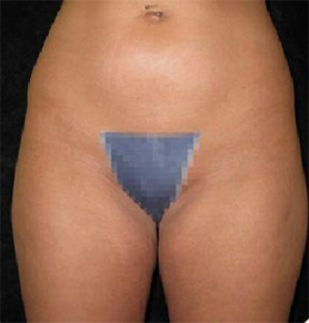 Liposuction Before and After Pictures Glastonbury, CT