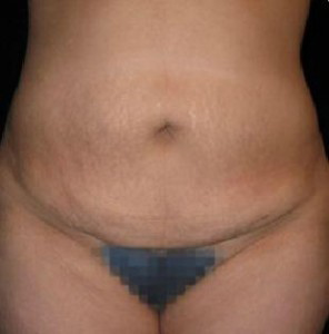 Liposuction Before and After Pictures Glastonbury, CT