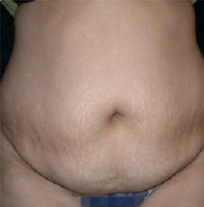 Liposuction Before and After Pictures Glastonbury, CT