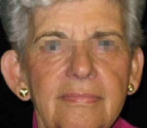 Otoplasty Before and After Pictures Glastonbury, CT
