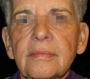 Otoplasty Before and After Pictures Glastonbury, CT