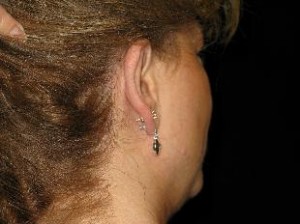 Otoplasty Before and After Pictures Glastonbury, CT