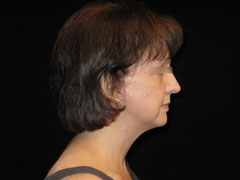 Facelift Before and After Pictures Glastonbury, CT