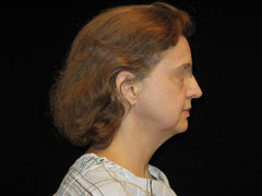 Facelift Before and After Pictures Glastonbury, CT