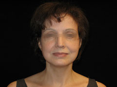 Facelift Before and After Pictures Glastonbury, CT