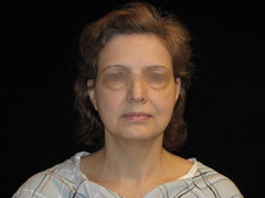 Facelift Before and After Pictures Glastonbury, CT