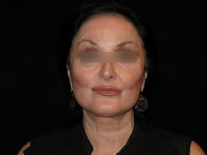Facelift Before and After Pictures Glastonbury, CT