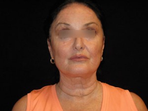 Facelift Before and After Pictures Glastonbury, CT