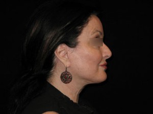 Facelift Before and After Pictures Glastonbury, CT