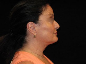 Facelift Before and After Pictures Glastonbury, CT