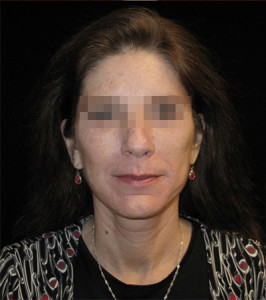 Facelift Before and After Pictures Glastonbury, CT