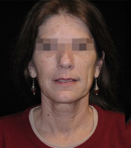 Facelift Before and After Pictures Glastonbury, CT