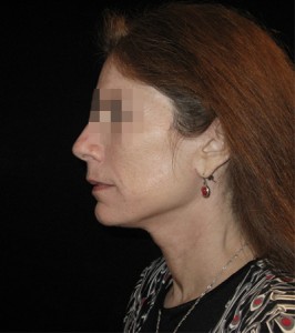 Facelift Before and After Pictures Glastonbury, CT