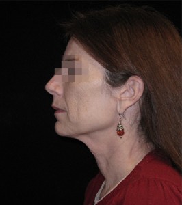 Facelift Before and After Pictures Glastonbury, CT
