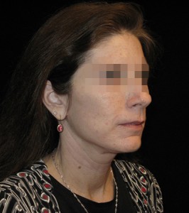 Facelift Before and After Pictures Glastonbury, CT