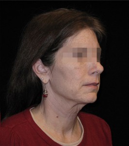 Facelift Before and After Pictures Glastonbury, CT