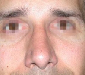 Rhinoplasty Before and After Pictures Glastonbury, CT