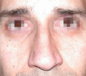 Rhinoplasty Before and After Pictures Glastonbury, CT