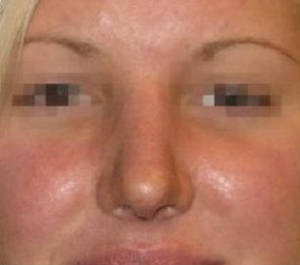 Rhinoplasty Before and After Pictures Glastonbury, CT