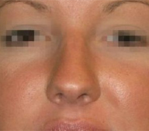 Rhinoplasty Before and After Pictures Glastonbury, CT