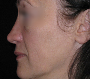 Rhinoplasty Before and After Pictures Glastonbury, CT