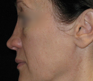 Rhinoplasty Before and After Pictures Glastonbury, CT