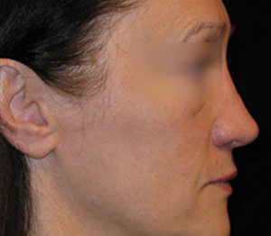 Rhinoplasty Before and After Pictures Glastonbury, CT