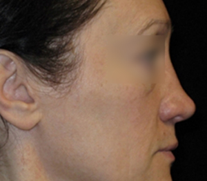 Rhinoplasty Before and After Pictures Glastonbury, CT