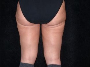 Thigh Lift Before and After Pictures Glastonbury, CT